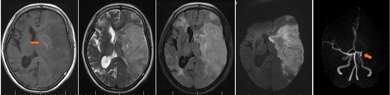 张x，76y，被人发现意识不清3天，加重20小时